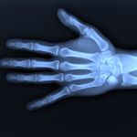 10 Symptoms and Treatments of Mallet Finger