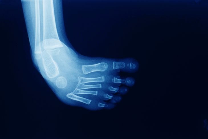 What is Clubfoot? Treatments and Symptoms