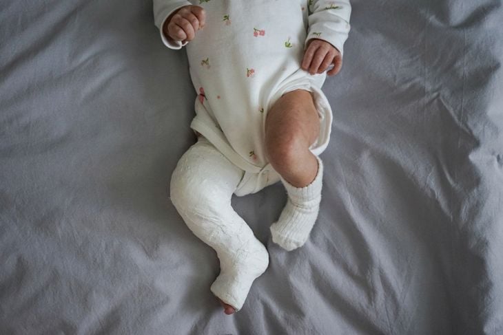 Newborn little baby with leg in a cast - clubfoot