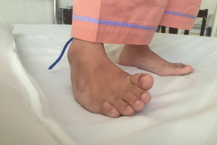 Photograph of an older child's untreated clubfoot