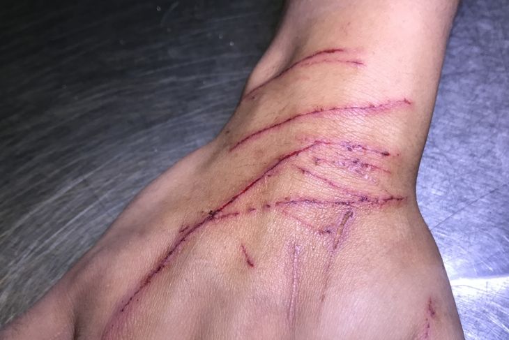Cat Scratch Disease: A Comprehensive Guide to its Symptoms and Treatments