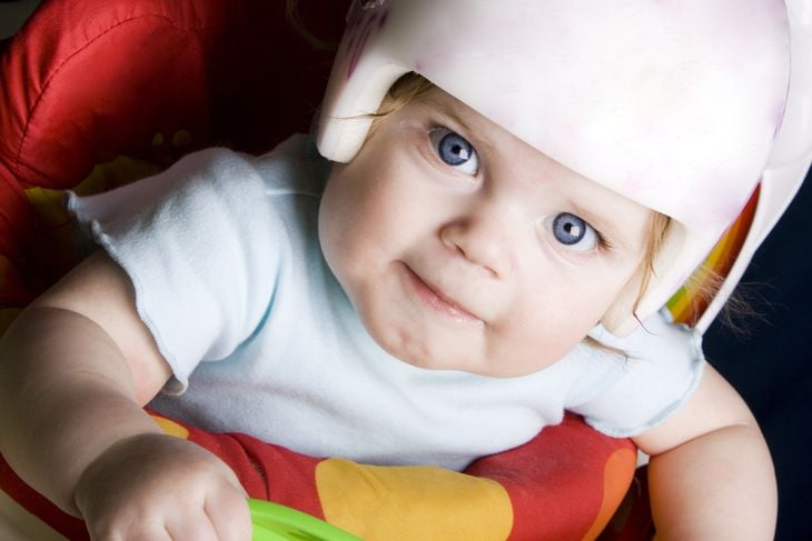 10 FAQs about Plagiocephaly