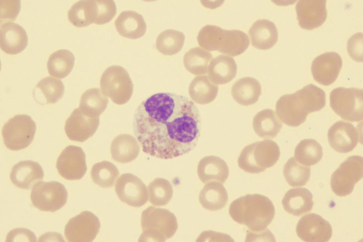 Symptoms and Treatments of Myelodysplastic Syndrome