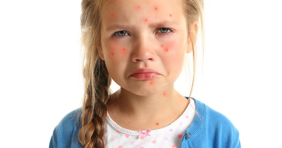 What is Chickenpox? Symptoms and Treatment Facty Health