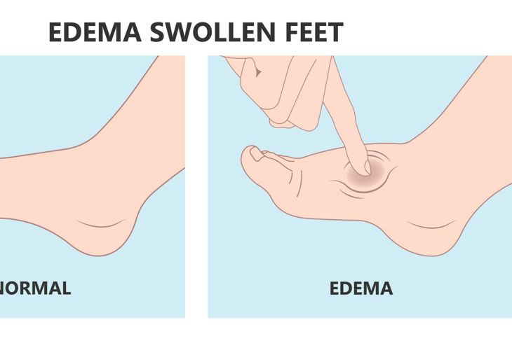 edema