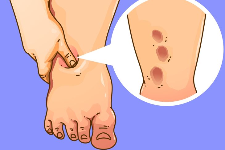 Recognizing and Treating Edema