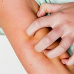 Symptoms and Treatments of Pruritus
