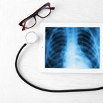 Learn How Bronchiectasis Affects Lung Health