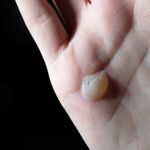10 Symptoms and Treatments of Bullous Pemphigoid