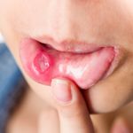 Understanding Behcet's Disease: Symptoms and Treatments