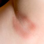 10 Causes and Symptoms of Folliculitis