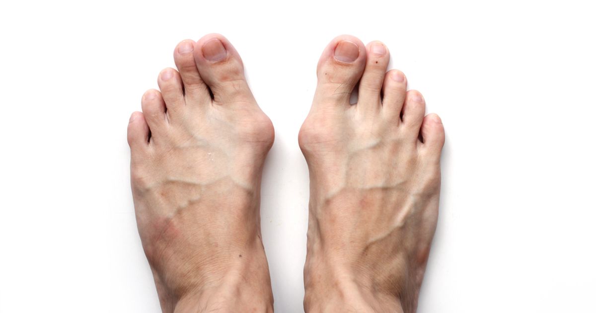 10 Symptoms and Treatments of Hallux Valgus - Facty Health