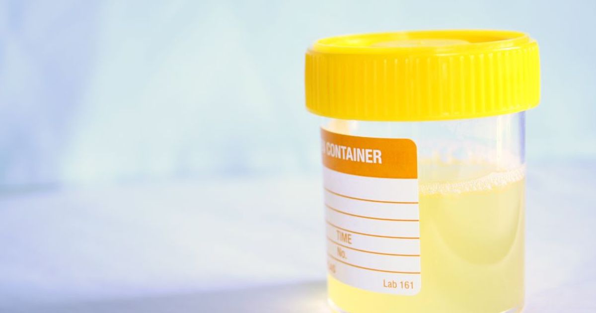 Causes, Symptoms, and Treatments of Cloudy Urine Facty Health