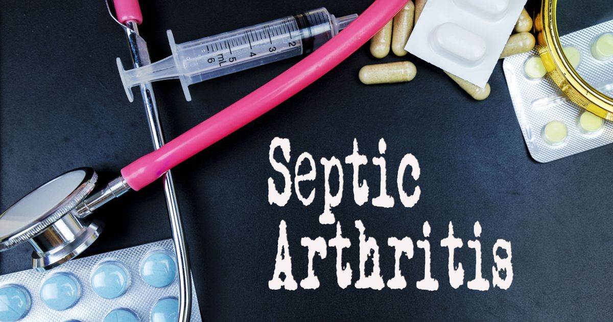 Symptoms, Causes, and Treatments for Septic Arthritis Facty Health