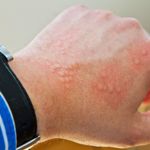 Symptoms and Treatments for Miliaria