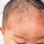 10 Frequently Asked Questions about Cradle Cap