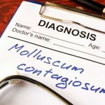 10 Symptoms, Causes, and Treatments: Molluscum Contagiosum
