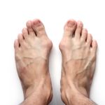 10 Symptoms and Treatments of Hallux Valgus
