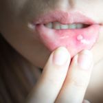 8 Causes of a Mouth Ulcer