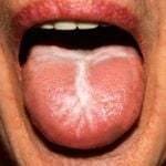 10 Factors Leading to White Tongue and Their Solutions