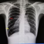 10 Causes, Symptoms, and Treatments: Pneumothorax