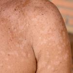 Symptoms and Treatments of Pityriasis Versicolor