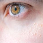 Symptoms, Causes, and Treatments for Milia