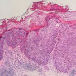 Symptoms and Treatments for Bowen's Disease