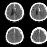 10 Ways to Manage Subdural Hematoma at Home