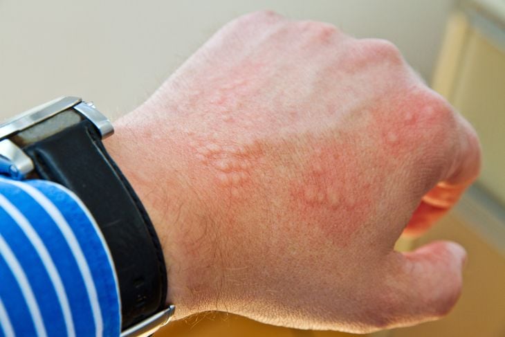 Symptoms and Treatments for Miliaria