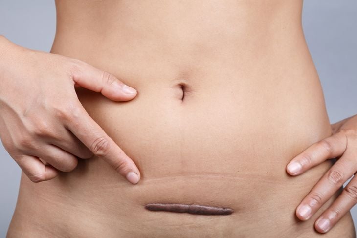 10 Symptoms and Treatments for Keloids
