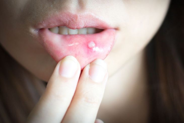 8 Causes of a Mouth Ulcer