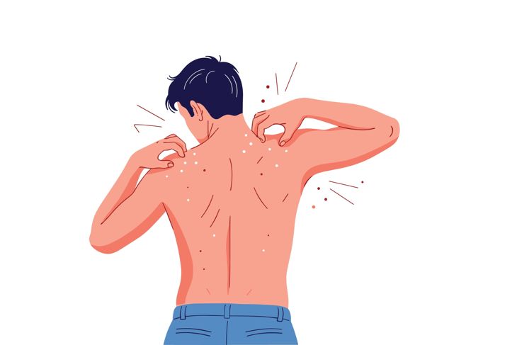 Man scratching itchy back