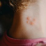 Spider Bites: Symptoms, Causes, and Essential Treatments