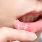 Treatment for Mouth Ulcer