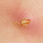 10 Treatments for Boils