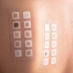 Hypersensitivity: Causes and Treatments