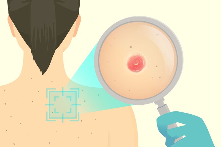 Squamous Cell Carcinoma: From Diagnosis to Prognosis