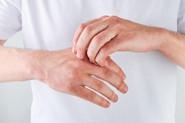 A person scratching the back of their hand, which appears red and irritated, possibly due to atopic dermatitis (eczema). The individual is wearing a white shirt, and the focus is on the hands.