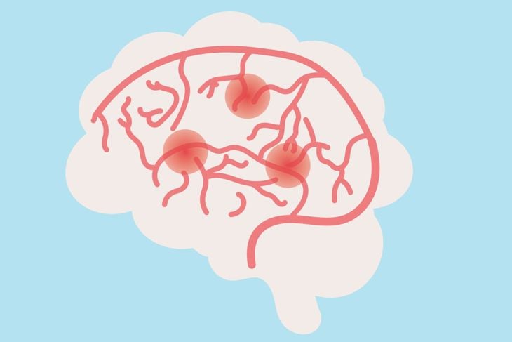 A transient ischemic attack (TIA) is a brief interruption of blood flow to the brain, causing stroke-like symptoms