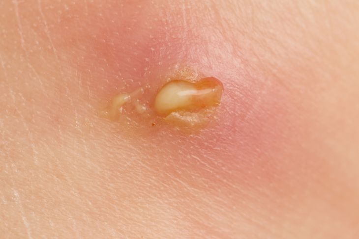 10 Treatments for Boils