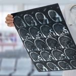 Frequently Asked Questions about Cerebral Angiography