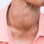 Treatments for Goitre