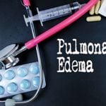 Common Questions Regarding Pulmonary Edemas