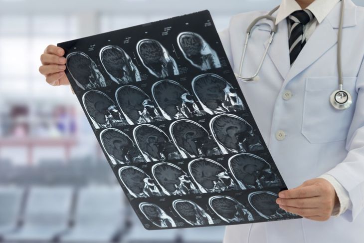 Frequently Asked Questions about Cerebral Angiography