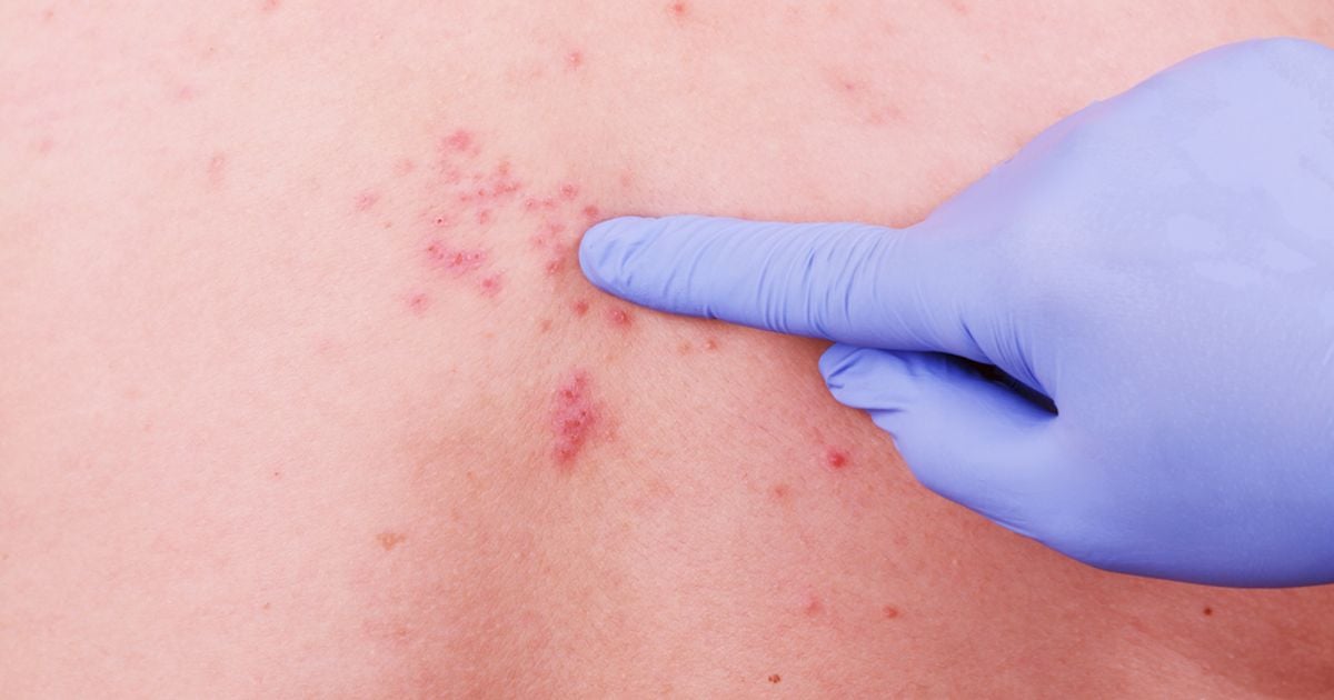 10 Symptoms, Causes, and Treatments of StevensJohnson Syndrome Facty