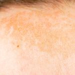 Get Rid of Dark Spots on Your Face
