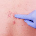 10 Symptoms, Causes, and Treatments of Stevens-Johnson Syndrome
