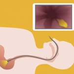 What You Need To Know About Nasoendoscopy