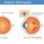 Signs, Causes, and Treatments of Diabetic Retinopathy